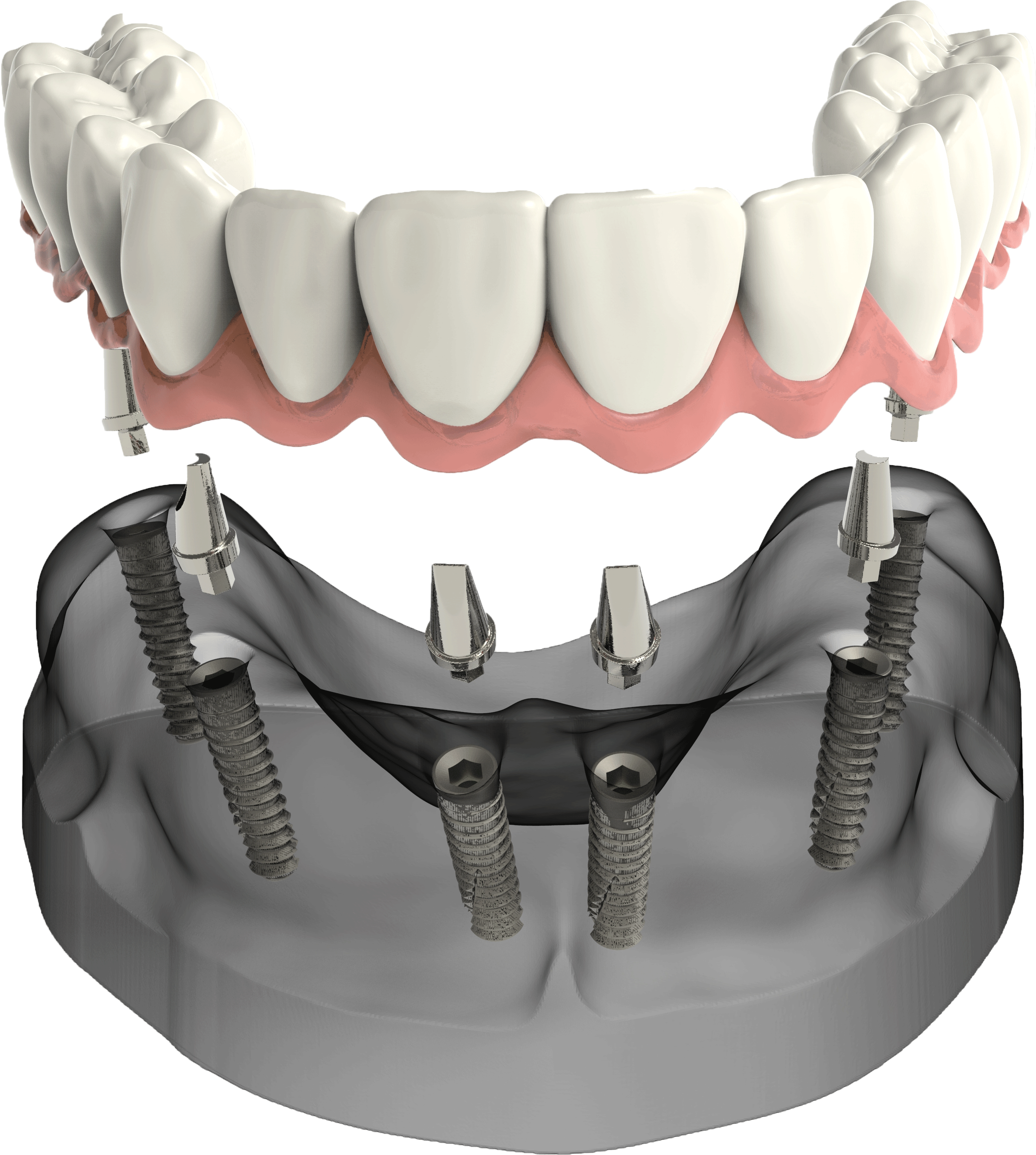 Имплантация зубов all on 4. Имплантологическая кассета Nobel полный набор для all on 4. Мостовидный протез на 6 имплантах. Имплантация зубов all on 6